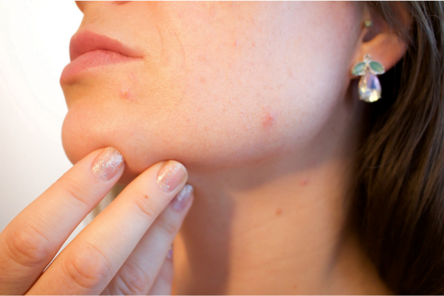 acne on woman's chin