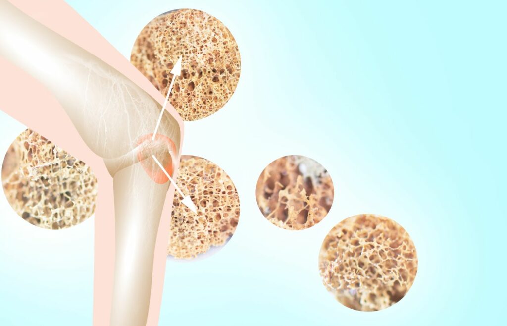 bone loss during and after menopause
